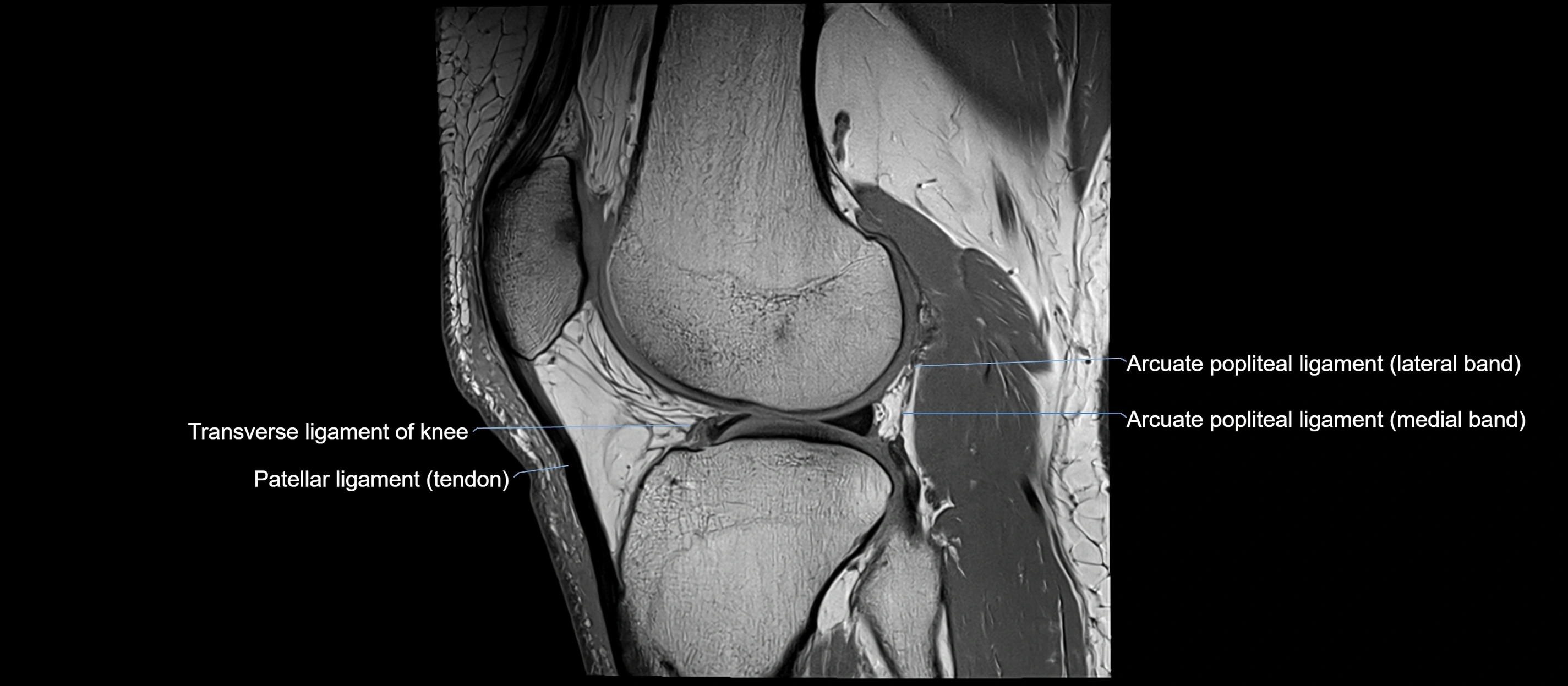 MRI sagittal  ligaments cross sectional anatomy 3T  radiology  image-img-00001-00032.webp